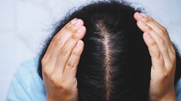 ما هو علاج اضطراب نتف الشعر؟